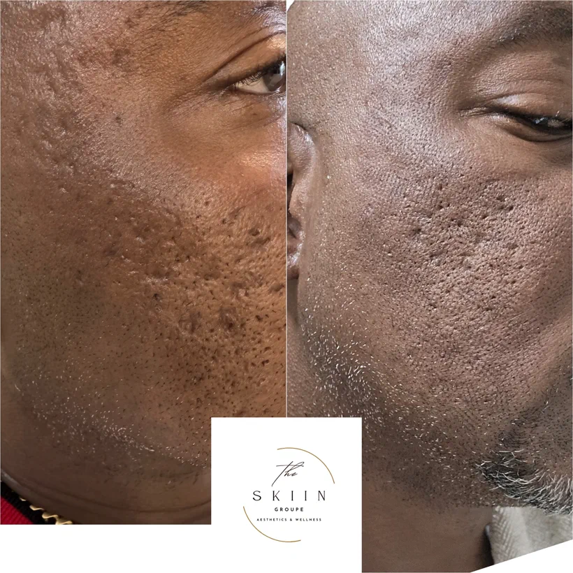 Before and after of acne-scar resurfacing showing smoother cheek texture