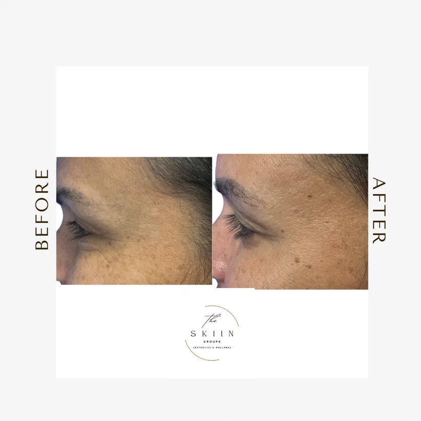 Before and after of Botox softening crow's feet around the eyes