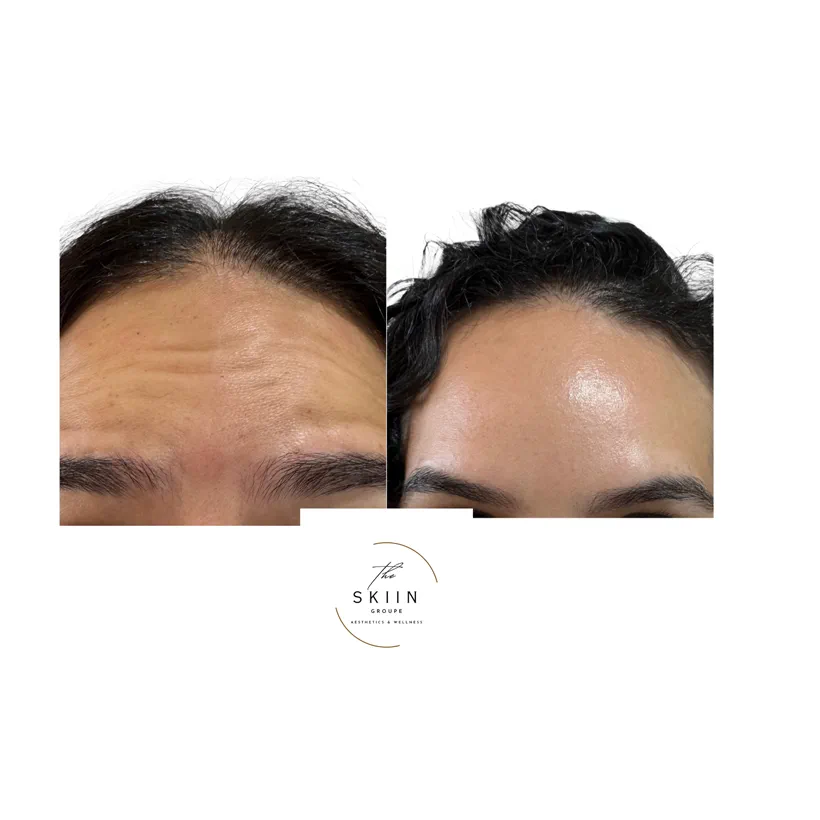 Before and after of Botox softening horizontal forehead lines and frown lines