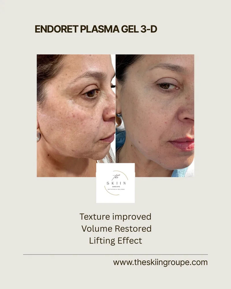 Before and after of Endoret Plasma 3-D Gel treatment improving skin texture, volume and lift