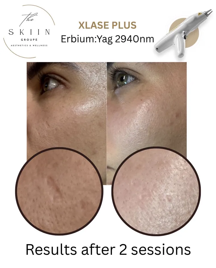 Before and after of XLase Plus Erbium:YAG fractional laser around the eye area, after two sessions