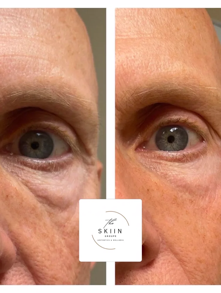Before and after of eye-area rejuvenation showing smoother, brighter under-eyes