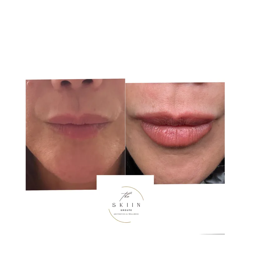 Before and after of a hyaluronic acid lip filler treatment showing fuller, more defined lips