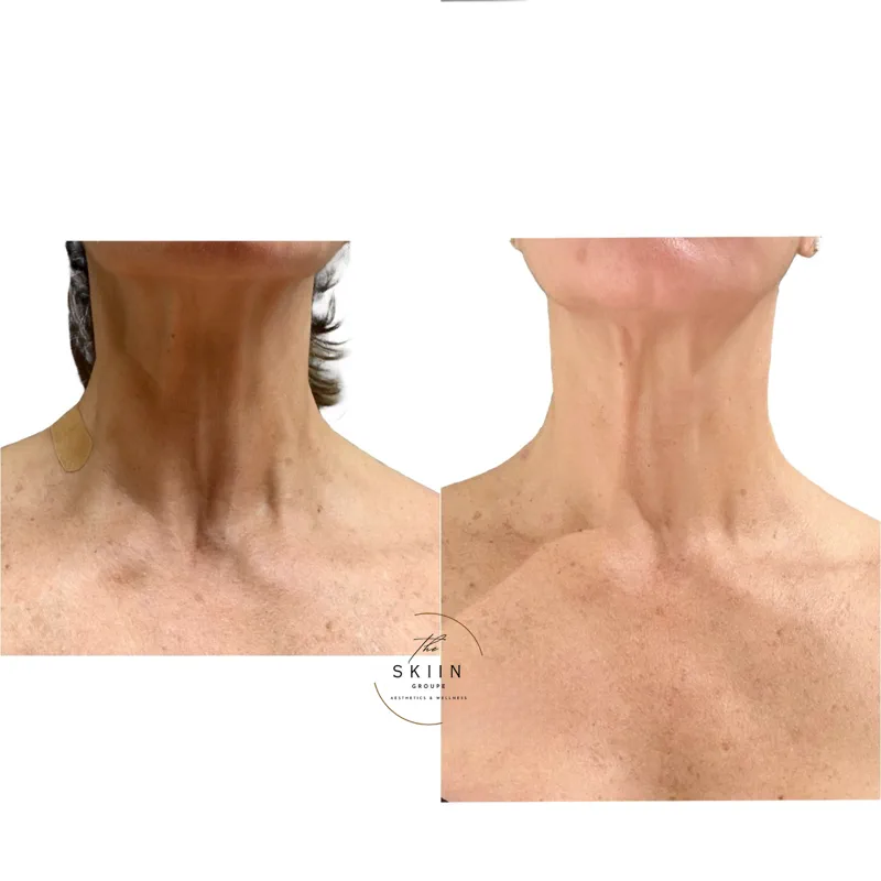 Before and after of neck and décolleté rejuvenation softening lines and improving skin quality