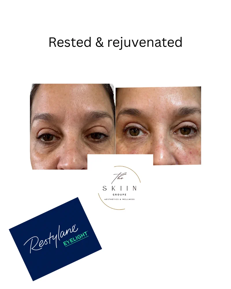 Before and after of Restylane Eyelight under-eye filler reducing hollows and dark circles