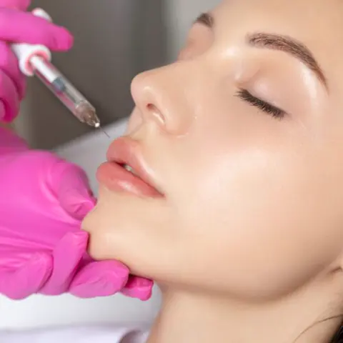 Lip filler treatment in progress