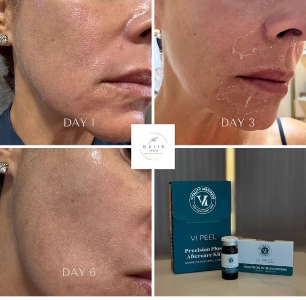 VI Peel results at day 1, 3 and 6 shown with the VI Peel Precision Plus aftercare kit